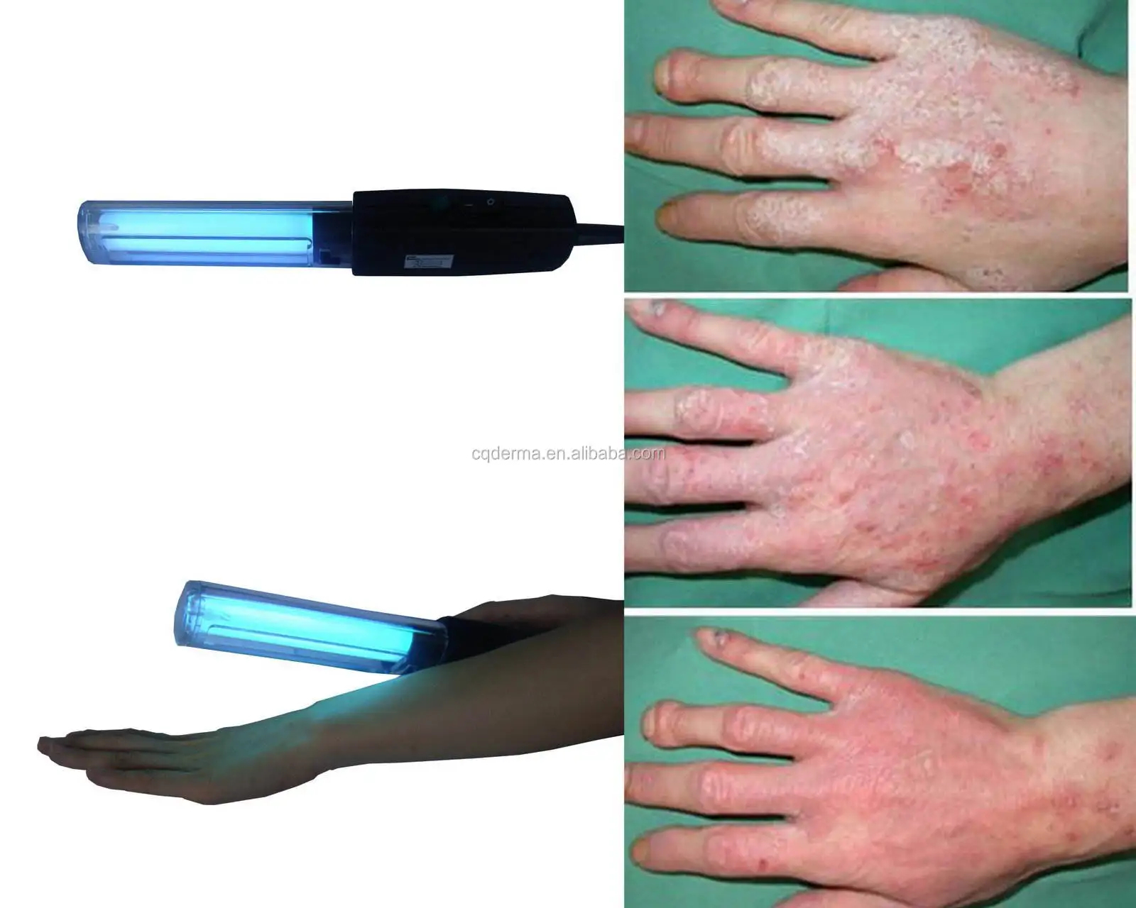 Narrowband 311 nm Uvb Lamp Vitiligo UVB Phototherapy Lamps For Psoriasis Vitiligo Treatment