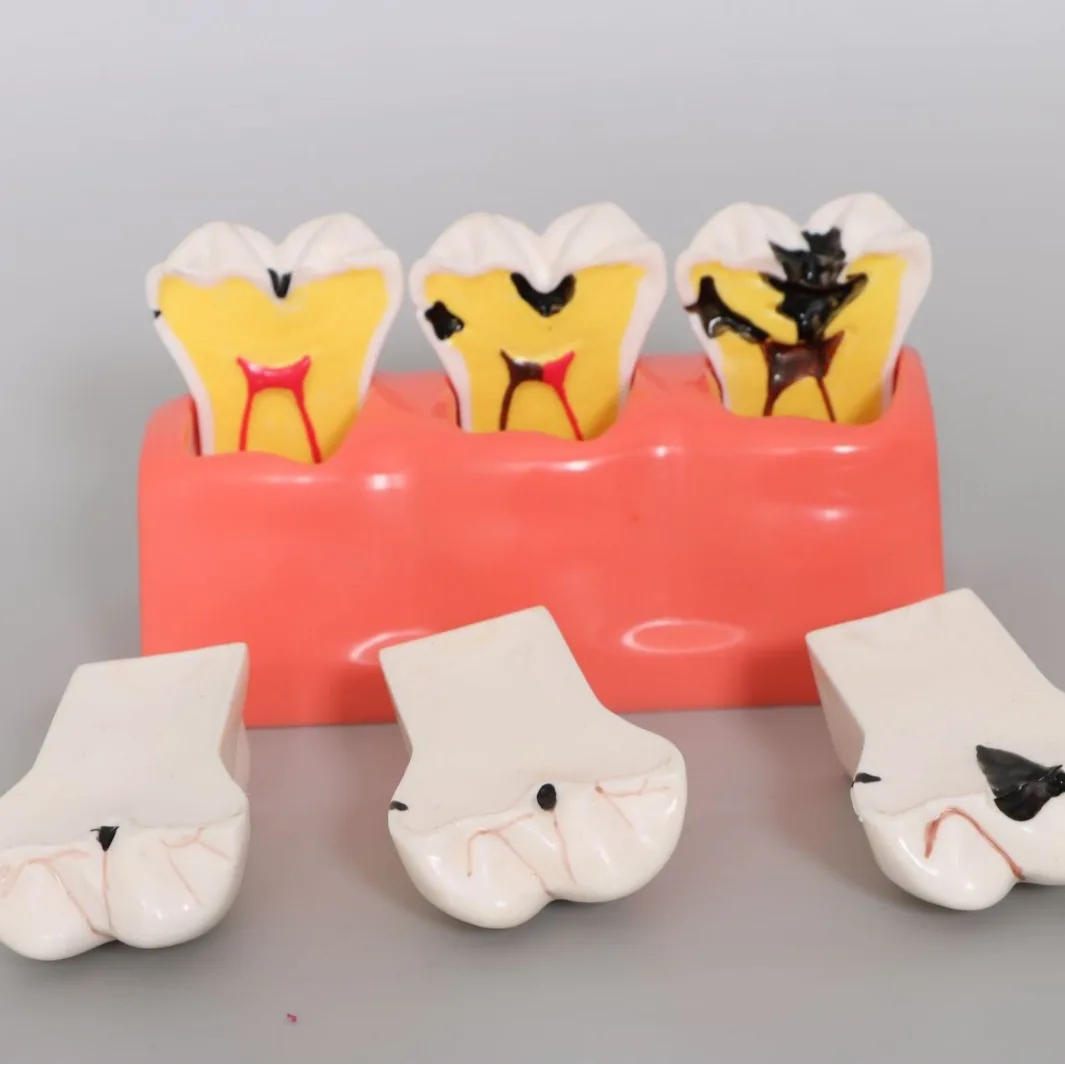 Dental model Dental caries evolution Patient communication model 3-stage four-fold caries decomposition model