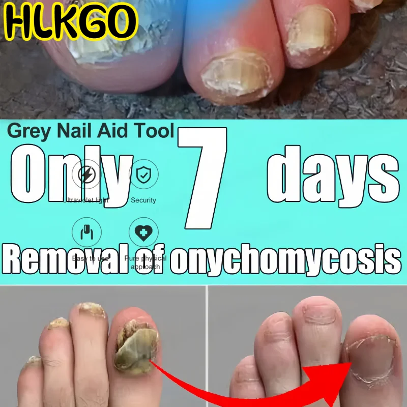 

Низкоуровневая лазерная терапия (LLLT) для лечения грибка ногтей, безопасного лечения онихомикоза на ногах