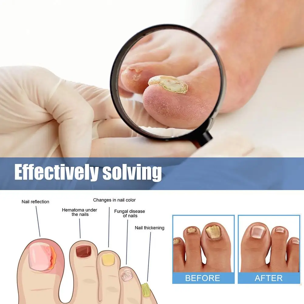 60pcs/Box Toenail Fungus Treatment Stickers Paronychia Removal Treatment Nail Ingrown Correction Stickers Pedicure Tools Care