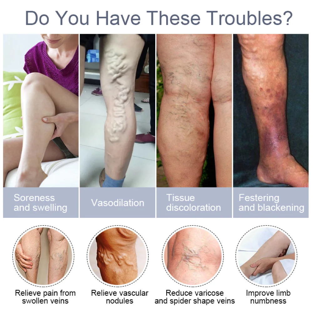 Varicose Vein Treatments Cream Effective Relieve Legs Dilated Vasculitis Phlebitis Spider Legs Natural Formula Ointment