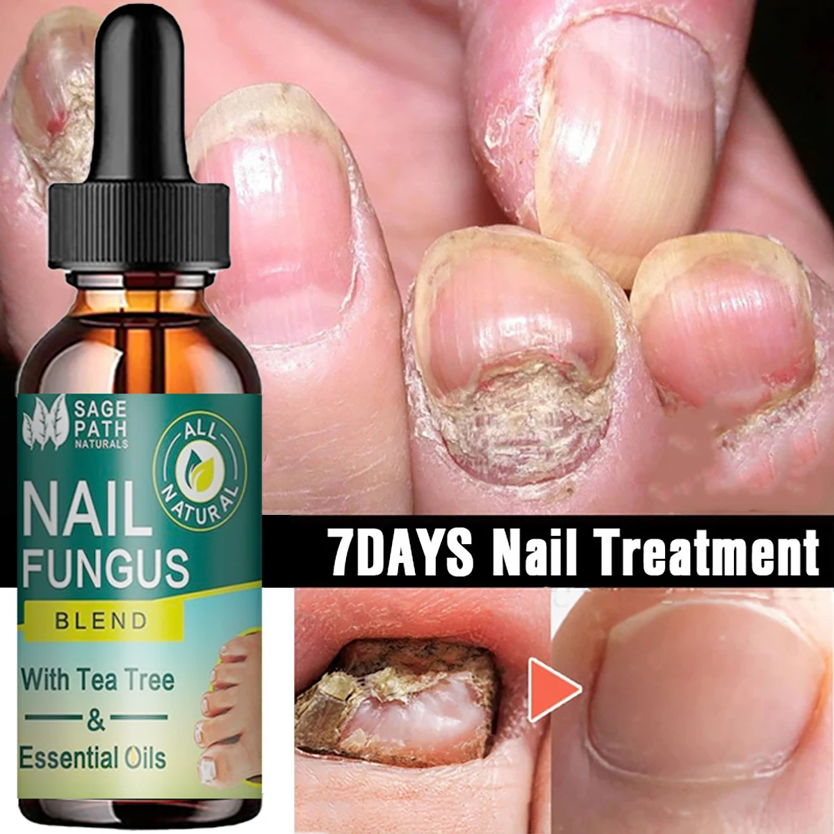 7DAYS Repair Nail Fungus Treatments Essence Foot Care Serum Toe Nails Fungal Removal Gel Anti-Infection