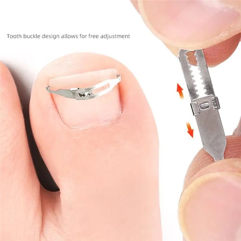 Professional Ingrown Toenail Correction Corrector Tools Foot Care Tool For Pedicure Recovery Embedding Toe Nails-A54Q
