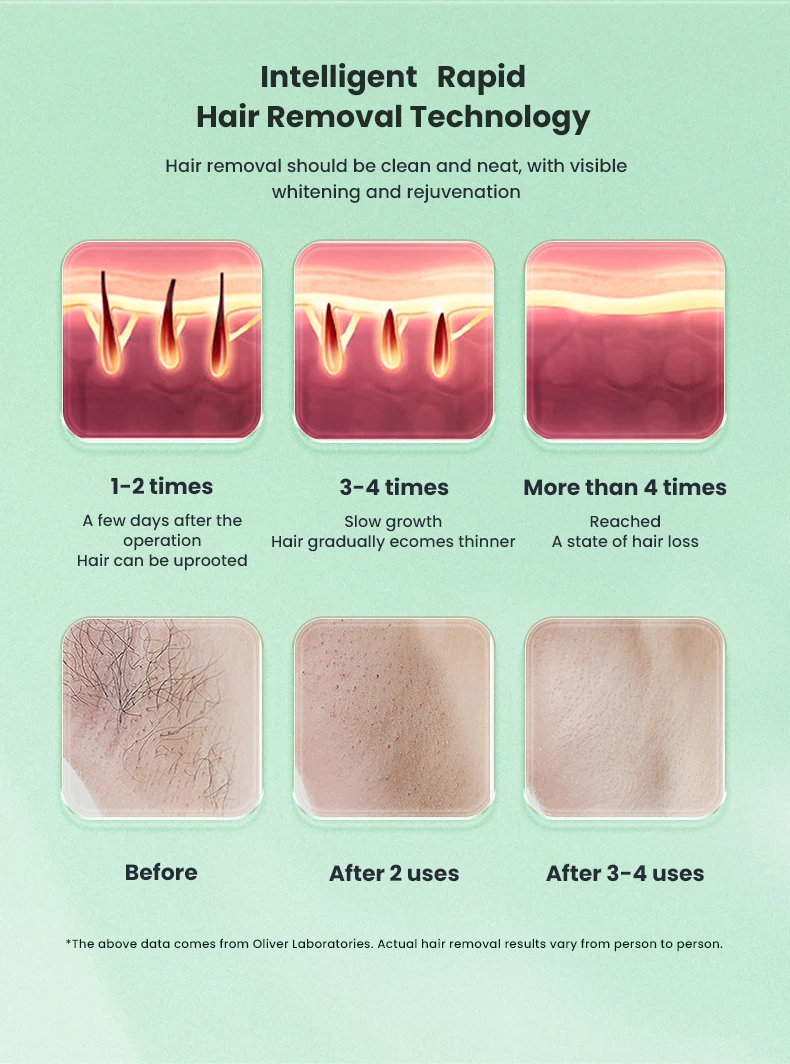 ماكينة إزالة الشعر بالليزر من البلاتين الجليدي القوية من الكسندريت سوبرانا، ماكينة ليزر ديود احترافية، مزيل شعر دائم للنساء #2