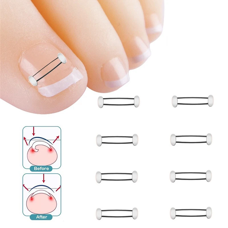 Ingrown Toenail Corrector Tools Pedicure Recover Embed Toe Nail Treatment Professional Ingrown Toenail Straightening Clip Brace