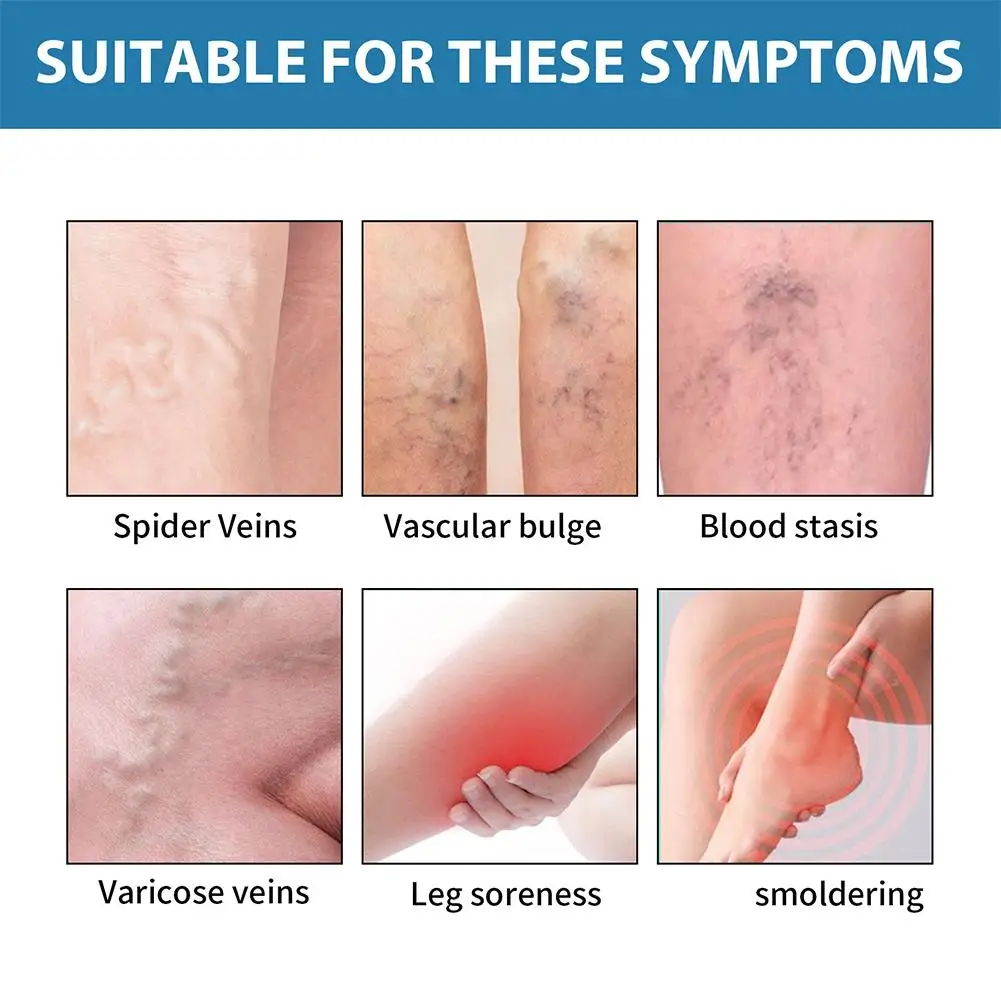 Creme de Tratamento de Veias Varicosas de Ação Rápida, Melhora a Circulação Sanguínea, Reduz a Perna, Inchaço, Acalma, Cansado