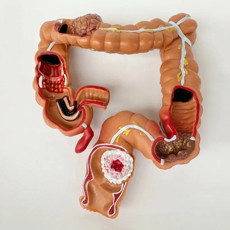 

Anatomy Human Visceral Colon Rectum Pathology Intestine Medical Anatomical Model