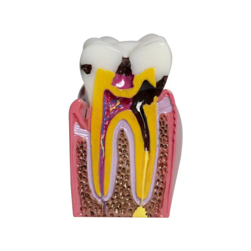 6 Times Dental Caries Comparsion Models Dental Teaching Model For Dental Study Teaching Dental Anatomy Endodontics Education