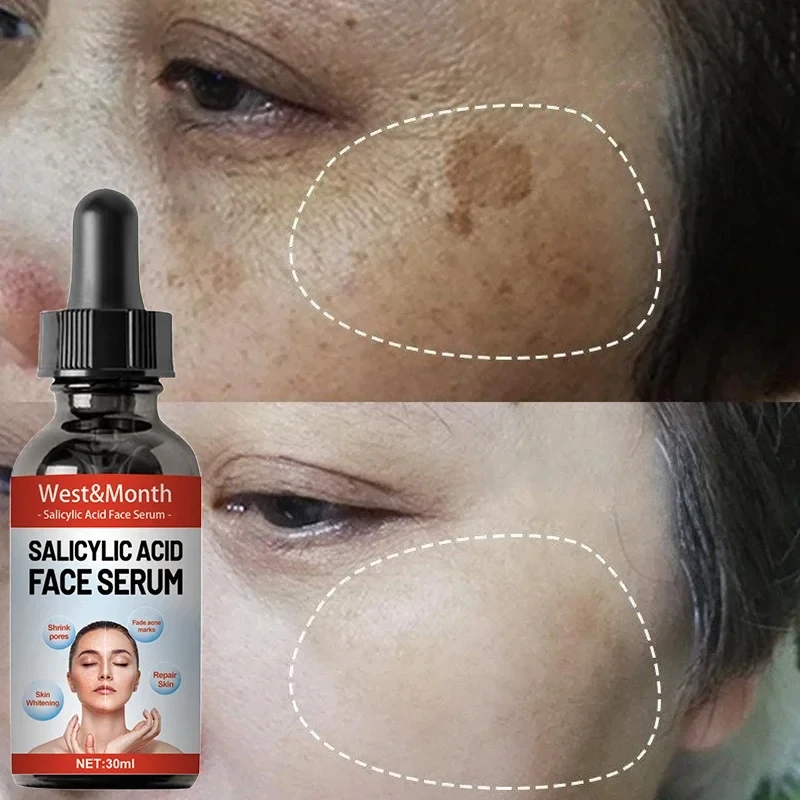 Powerful Spot-removing Whiten Facial Serum Niacinamide Salicylic Acid Moisturizing Korean Skin Care Products 2024