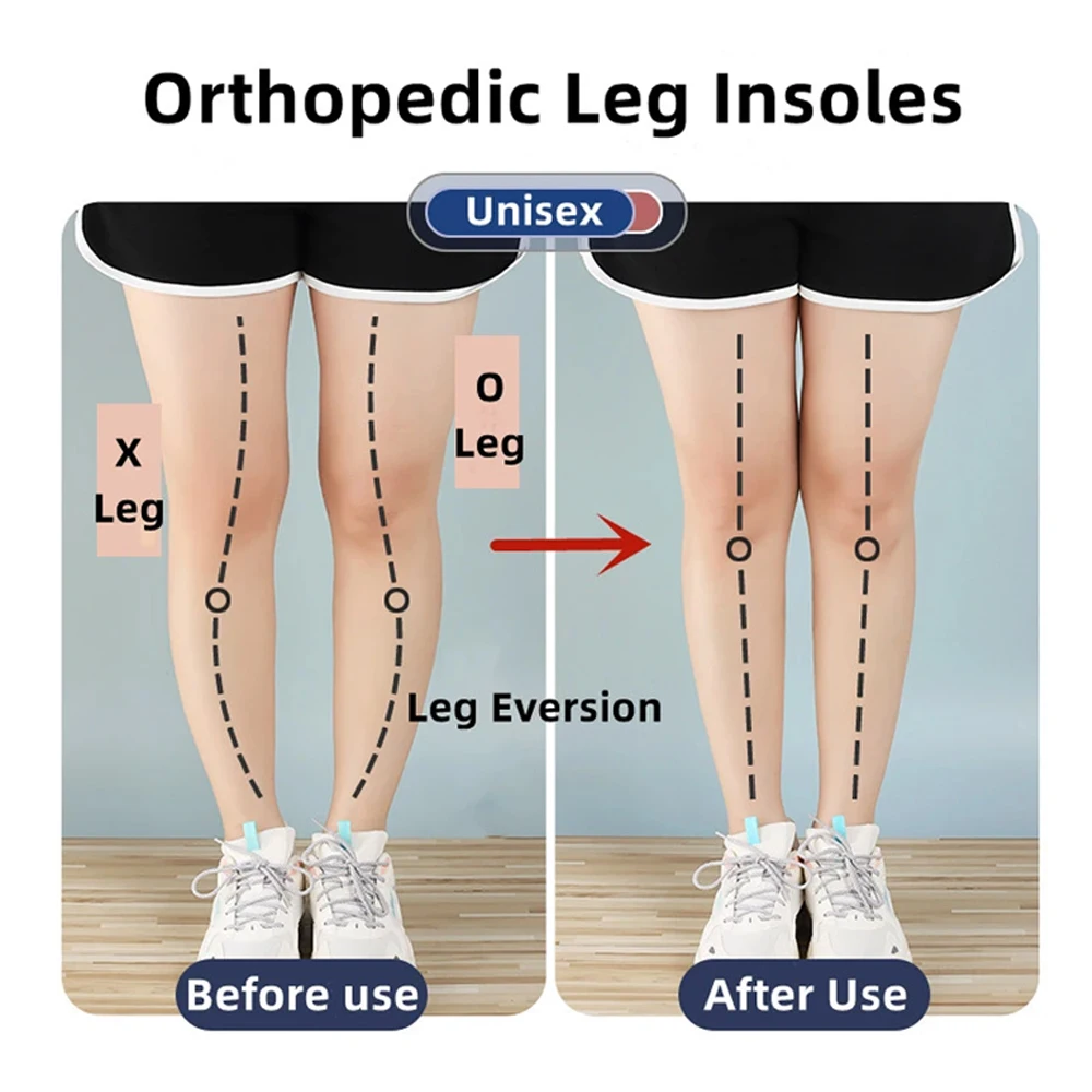 Magnetische orthopädische Silikon-Einlegesohlen für Schuhe, Männer und Frauen, Plantarfasziitis-Entlastung, O/X-Beine, Knie, Varus-Korrektur, Füße, Fersenpolster – Detail 11