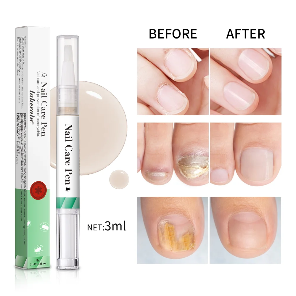 Nail Care Polish Mild Ingredients Prevent Damaged Nail Bed Treat Onychomycosis Nail Repair Pen For Nail Beauty Health Care Tools