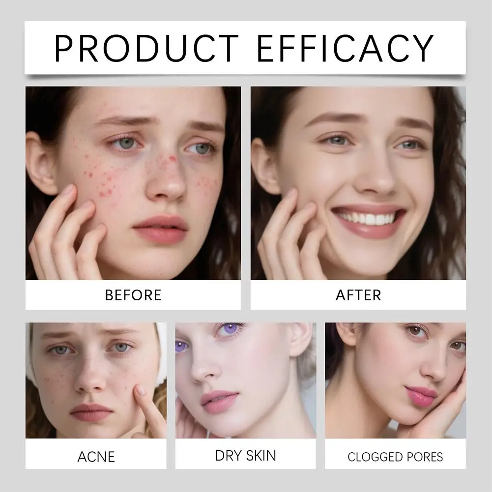 

New Facial Acne Patch Removal Patch Invisible Beauty Stickers Pimple Patch Concealer Absorbing Liquid Acne Cleansing Patch