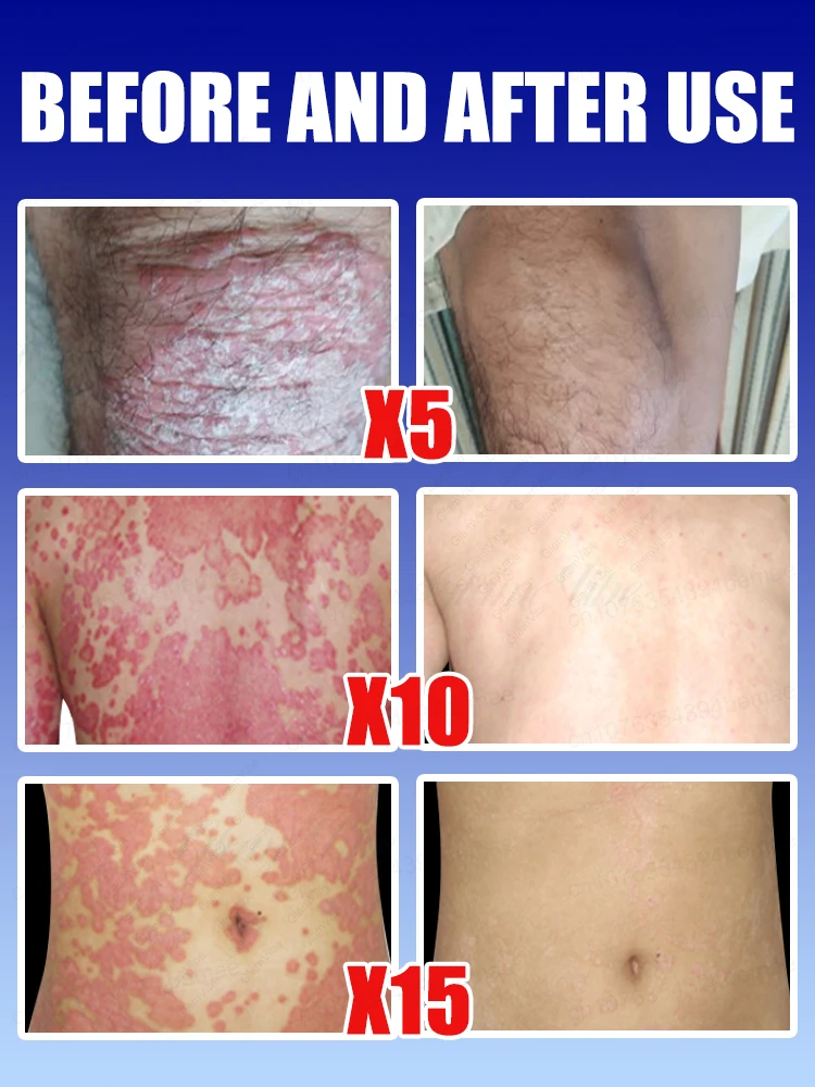 Healthy skin, happy self  ᴏᴠᴇʀᴄᴏᴍᴇ ɪᴛᴄʜɪɴɢ, ᴄᴏᴍғᴏʀᴛᴀʙʟᴇ ᴇᴠᴇʀʏ ᴅᴀʏ