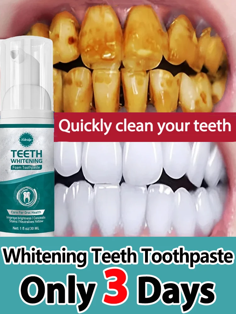 

Dental Calculus Remover Whitening Removal Bad Breath Teth Brightening Preventing Periodontitis Dental Cleansing Care