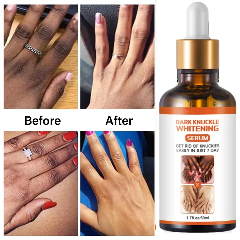 

Dark Knuckles Fast Brighten Serum Elbows Hand Knuckle Brightening Serum Knee Black Skin Quickly Lighten Stains Remover Essence