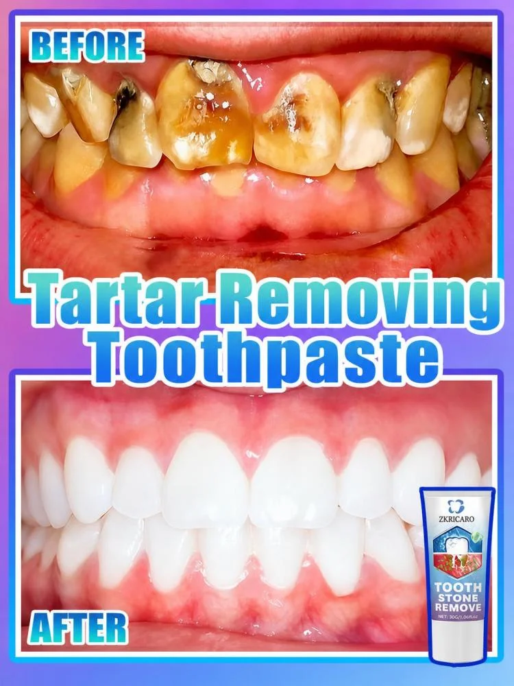 Repairing Toothpaste – Advanced removal of plaque, tartar, and stains; deep cleaning; cavity prevention; enamel repair; oral care.