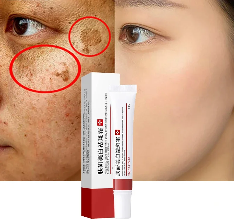 

1pcs Whitening Freckle Cream Remove Dark Spots Anti Freckle Cream Fade Pigmentation Melasma Brighten Creams Skin Care skin care