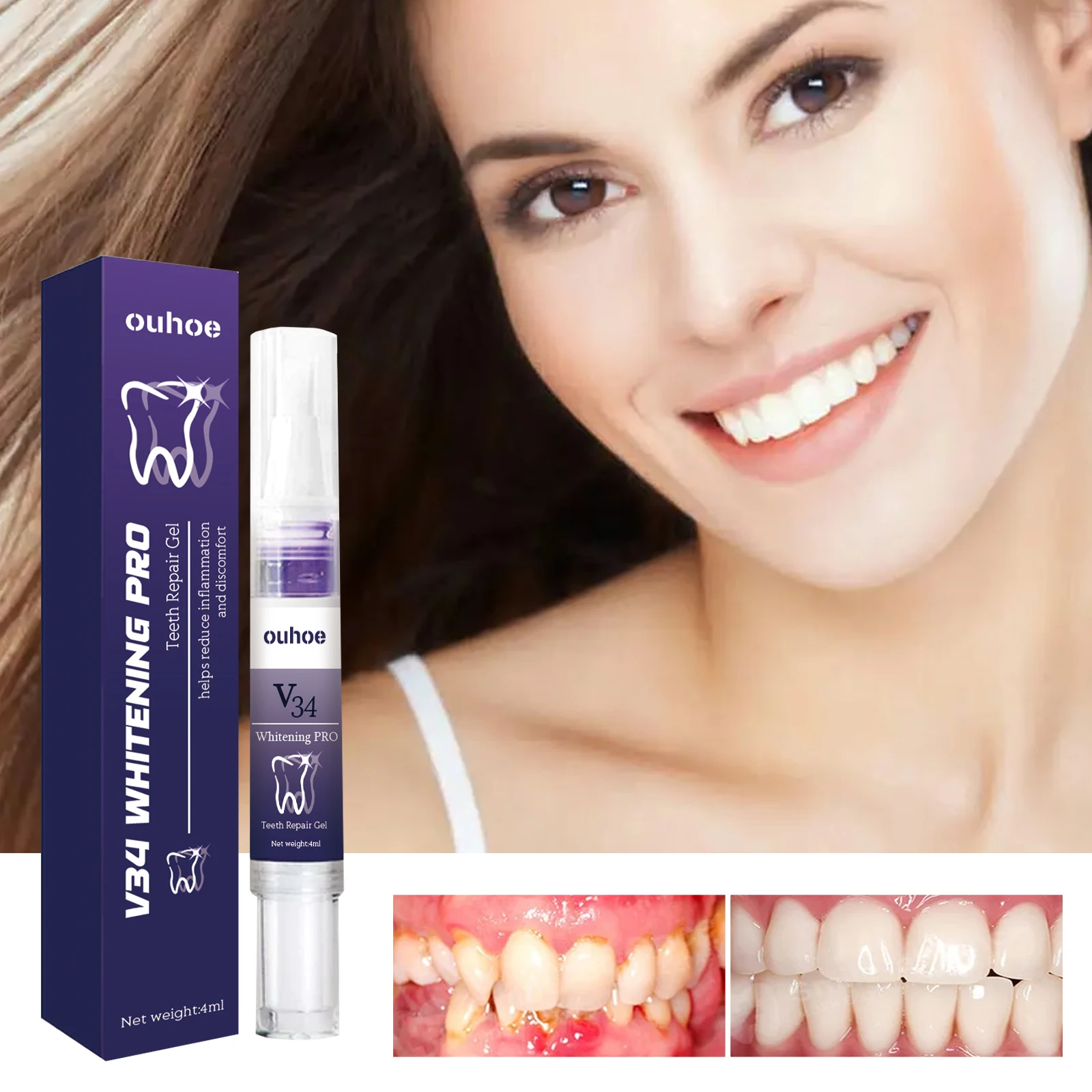 

Teeth Repair Gel – Soothes mouth blisters and gum inflammation, cleans tartar, whitens teeth