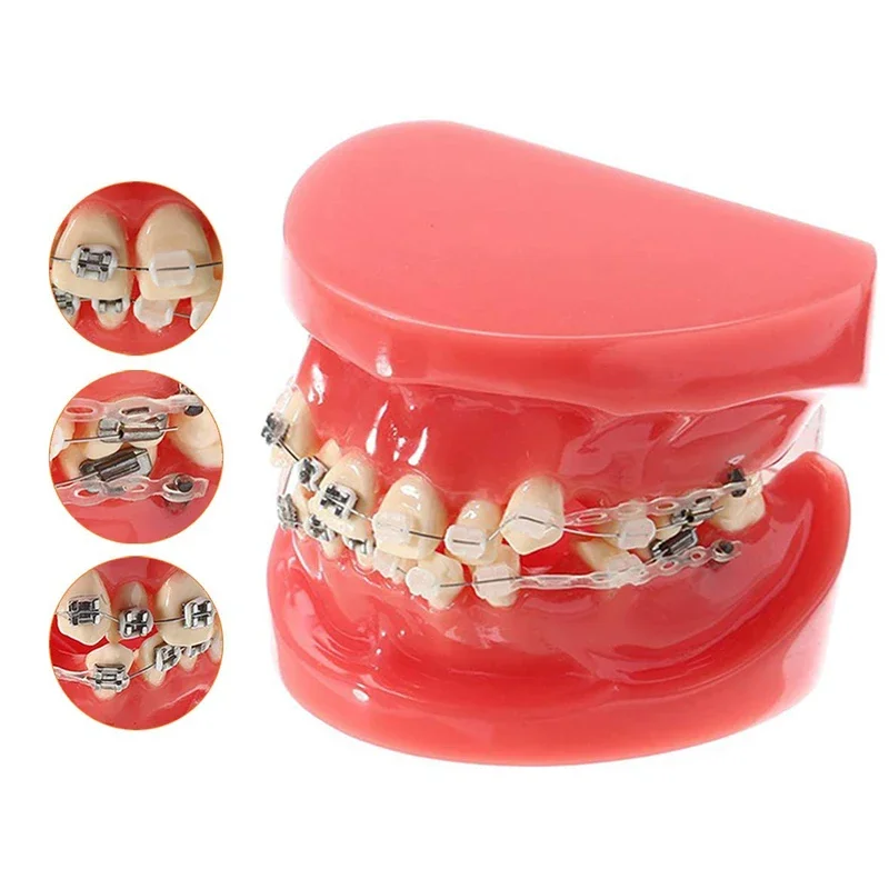 Dentist Orthodontic Treatment Model With Ceramic Metal Bracket Resin Orthodontic Teeth Model