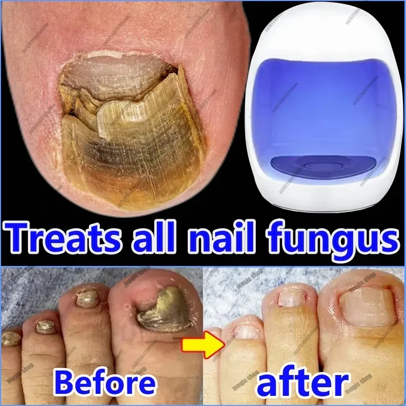 

About Fungal Nails, Laser Equipment, Fast Nail Repair, Fungal Nails