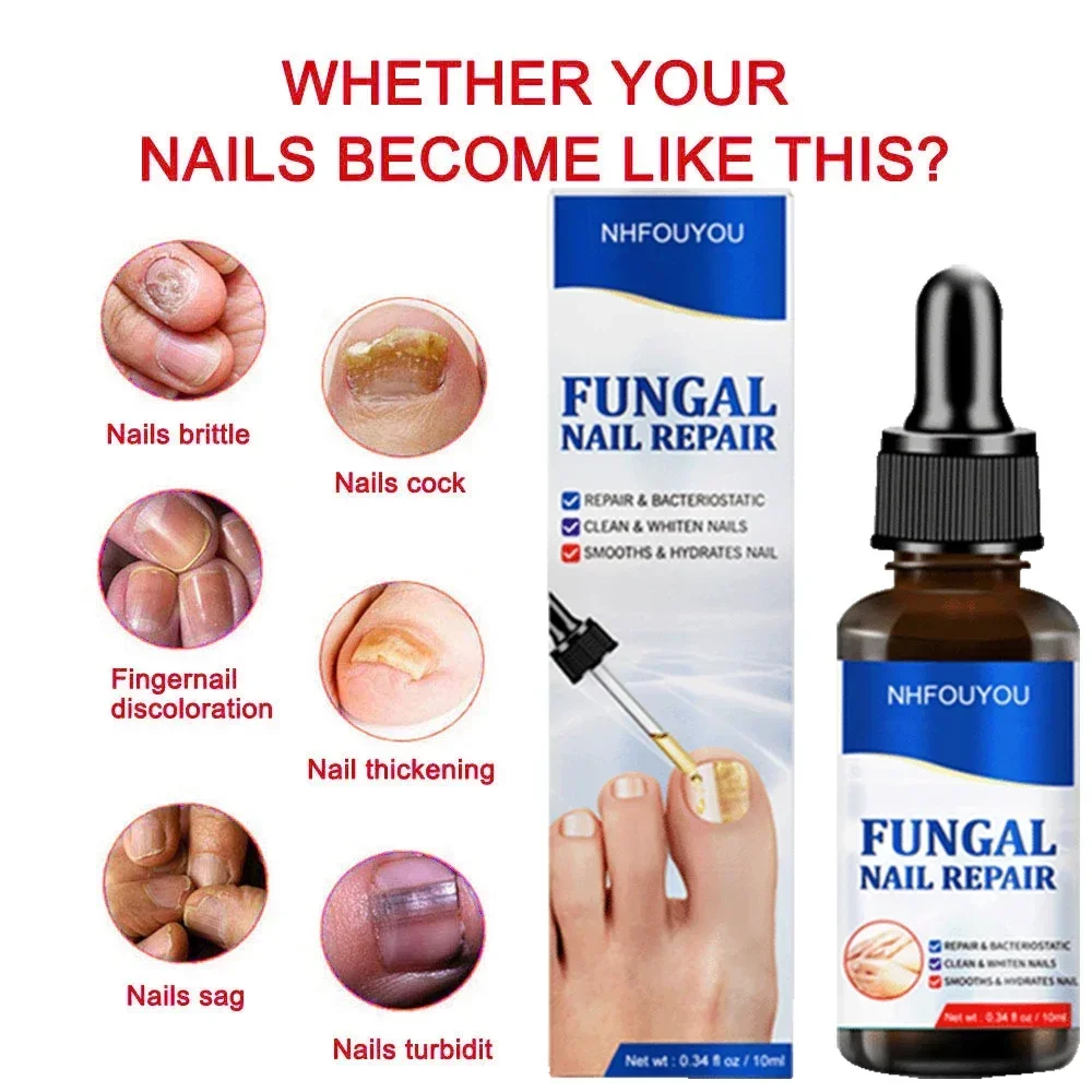 Nail Repair Líquido para Unhas descoloridas engrossadas amassadas, Fungals Renovação, Quebrado Rachado, S5F6