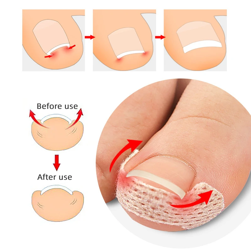 10Pcs/20Pcs/30Pcs Nail Correction Stickers Ingrown Toenail Corrector Patches Foot Care Tool Recover Corrector Pedicure Treatment