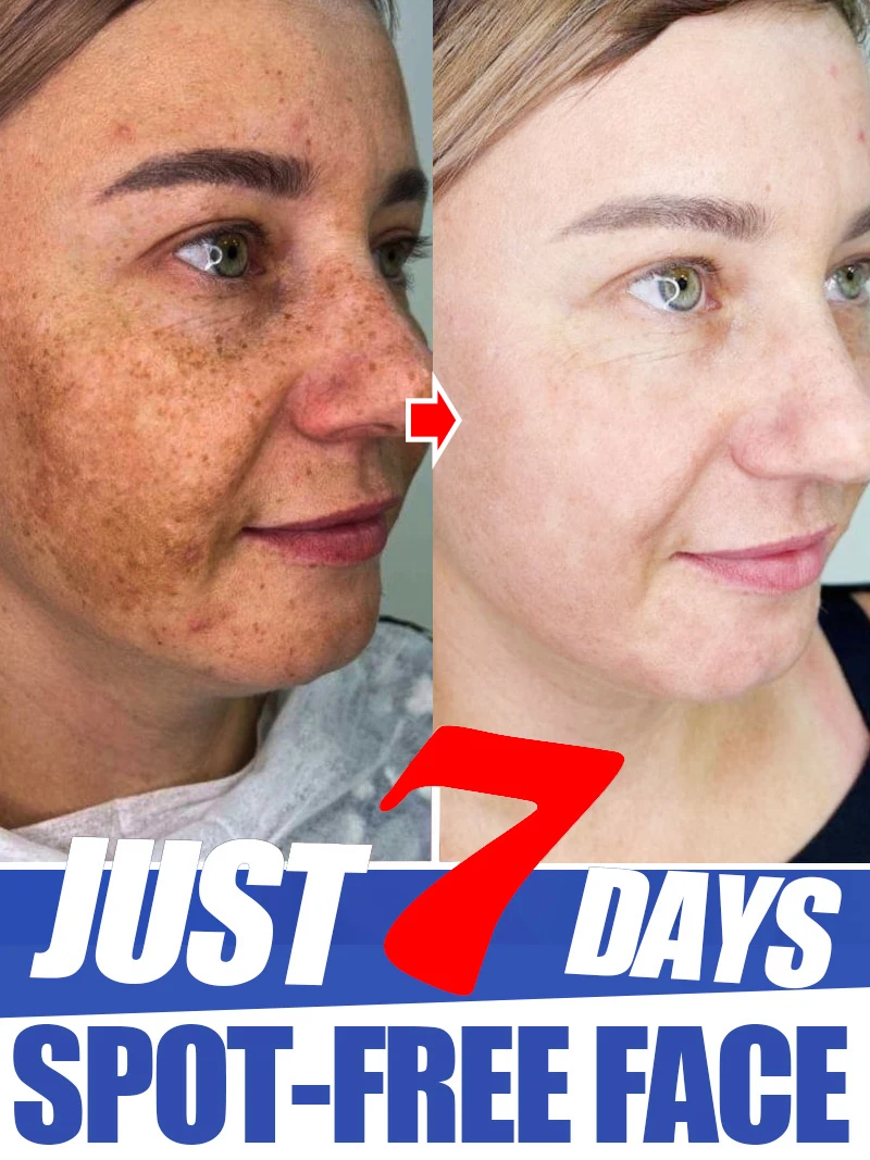 Lightening Facial Freckles Melasma Dark Spots