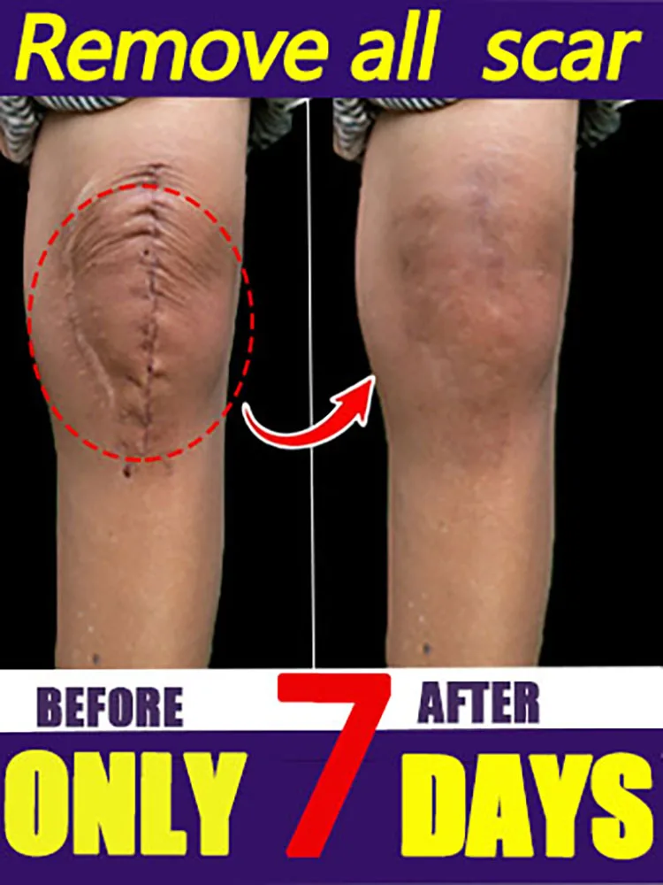 Herramientas de dispositivo de belleza para reparación de cuidado de la piel con láser para mujeres 	 y hombres