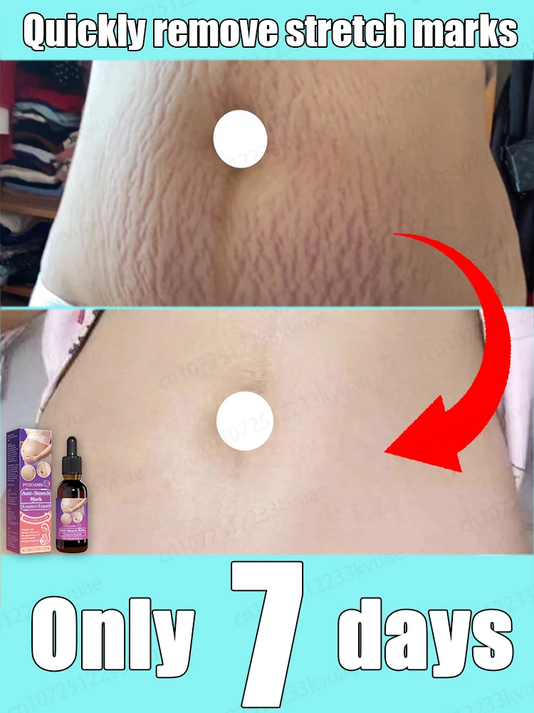Entfernen Sie Dehnungsstreifen, berechnen Sie Streifen vor, beseitigen Sie sich, beseitigen Sie keine Narben in nur 7 Tagen