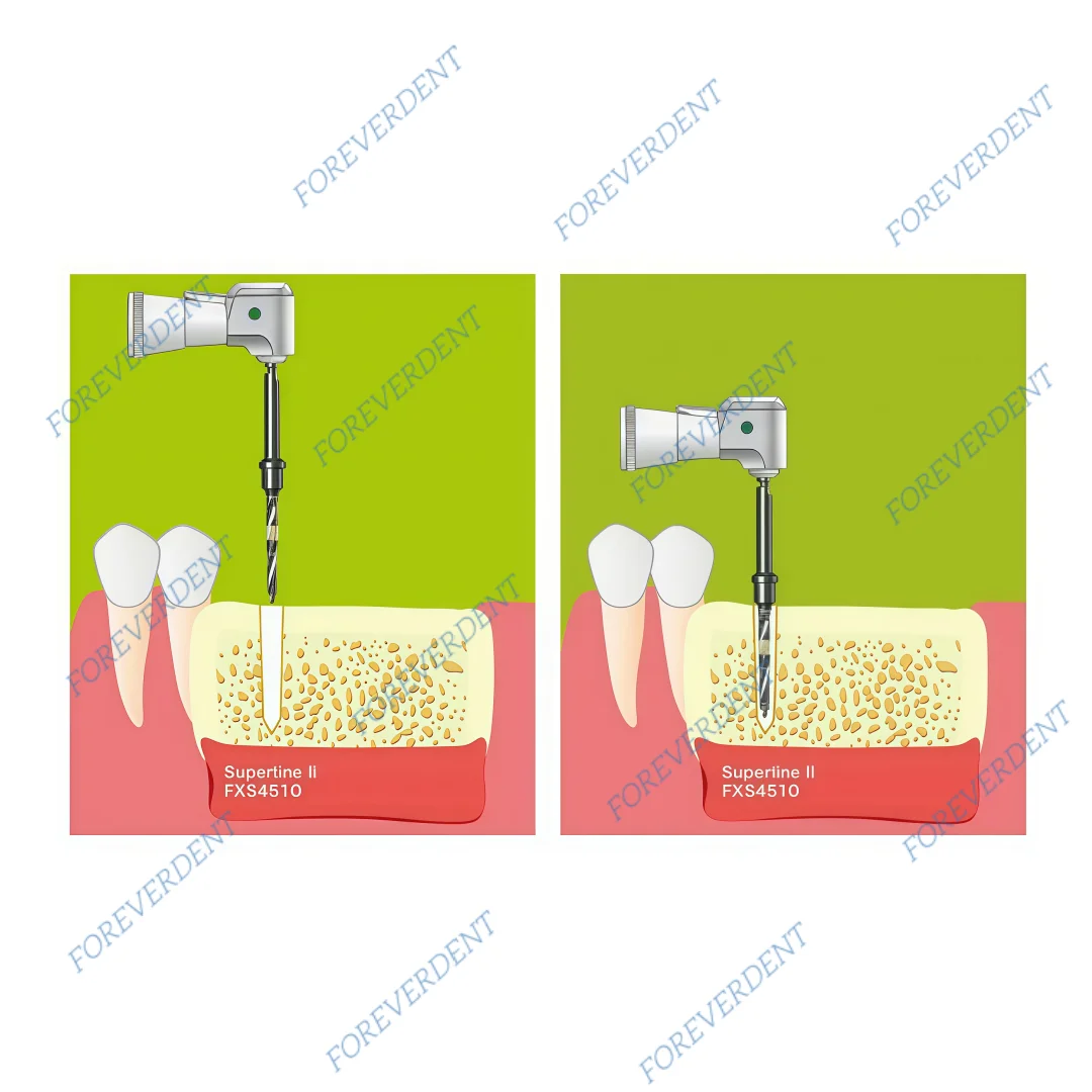 4Sizes Dental Cross Cutter Bone Side Cut Drill Implant Lindermann Graft Bit Dentist Clinic Lab Planting Tool Pre Drilling