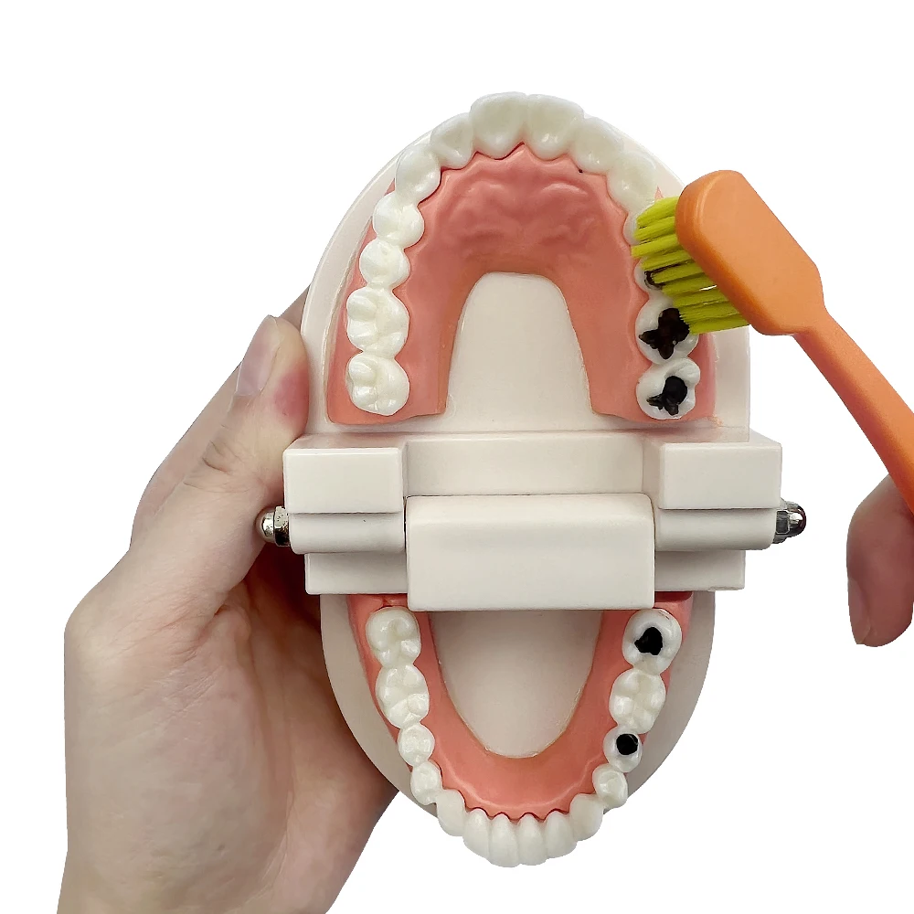 1 Stück Zahnmodell für Kinder und Erwachsene im Maßstab 1:1, Standardzahnmodell mit Karies eignet sich für Demonstrationen der Mundhygiene bei Zahnärzte