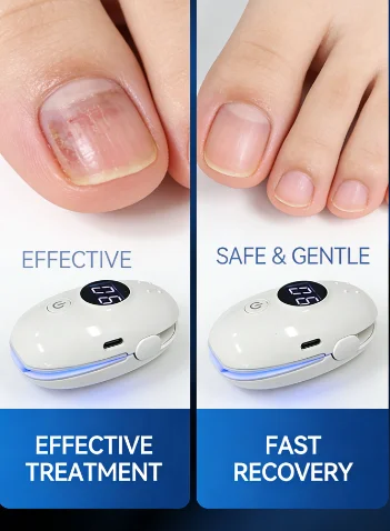 

Профессиональный лазерный прибор HZJ02 для удаления грибка ногтей, медицинский, для физиотерапии, быстрое заживление, от онихомикоза, противогрибковое средство