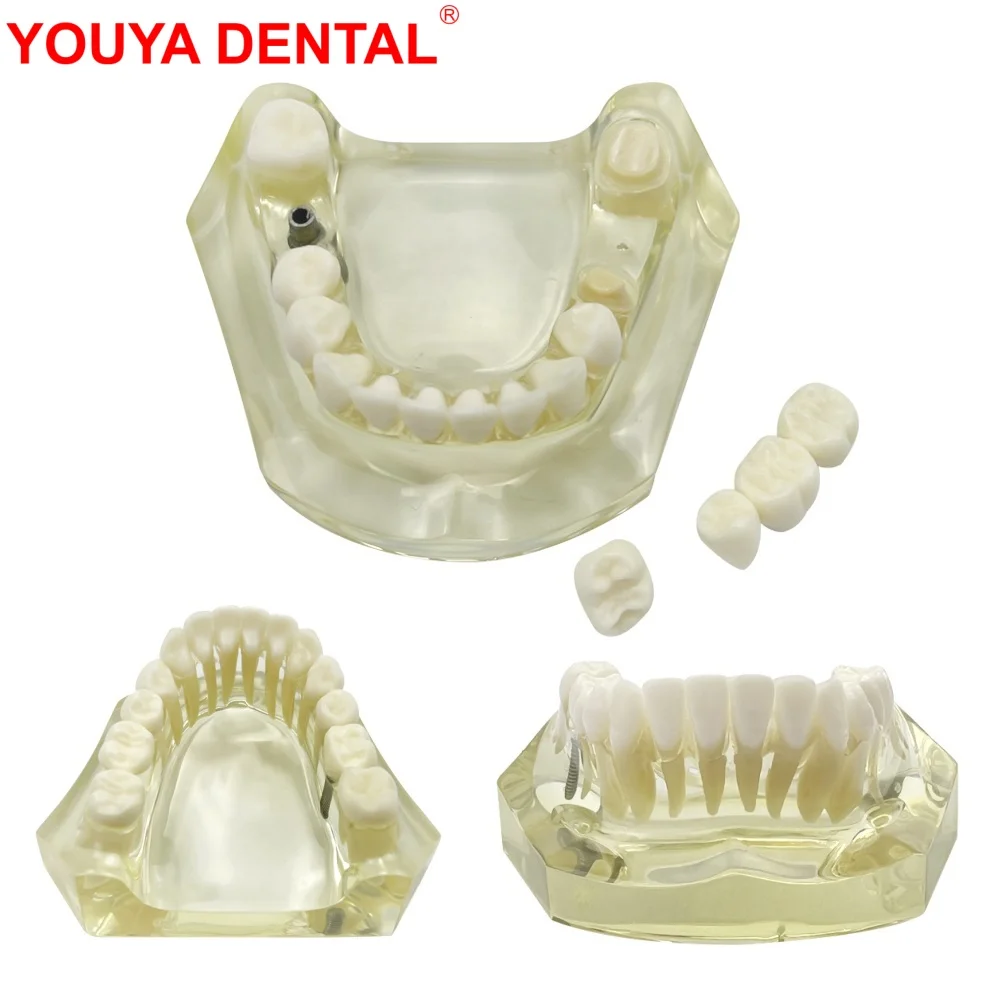 

Submaxillary Teeth Implant Model 1 Implants Restoration Dental Model With Removable Tooth For Studying Teaching Education Demo