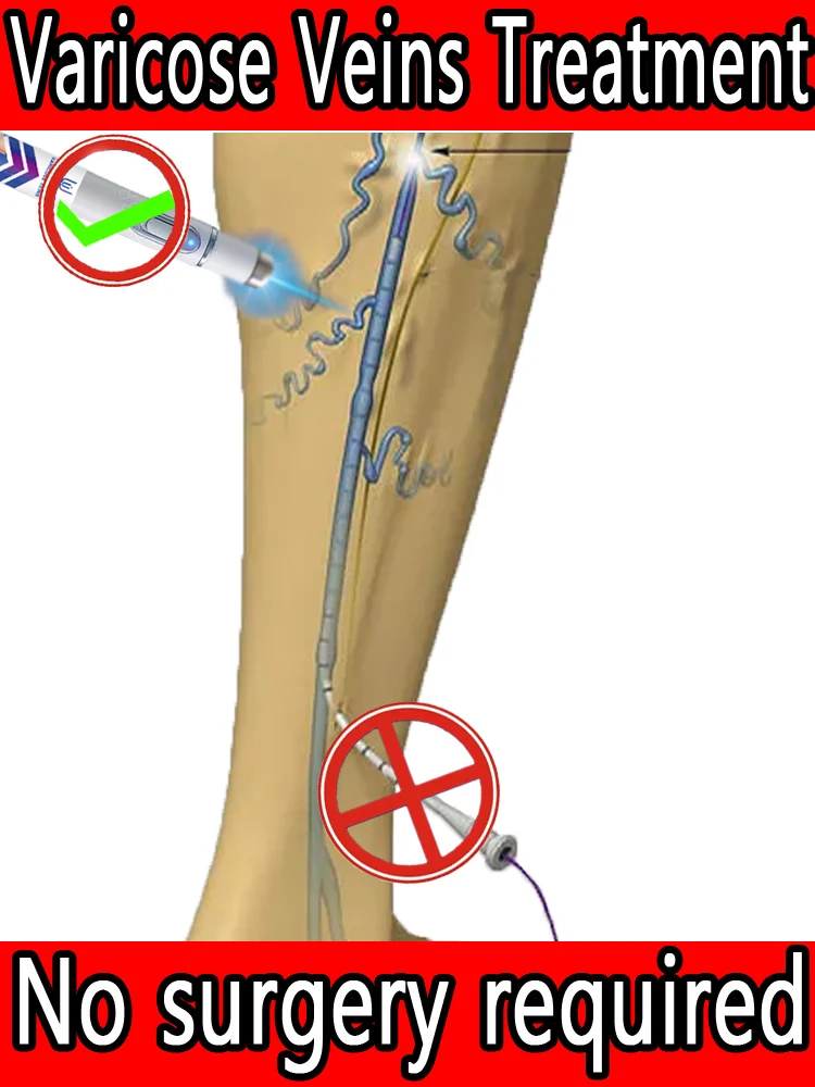 Effective treatment for varicose veins, relieves dilated vasculitis of leg phlebitis, avoids surgical pain