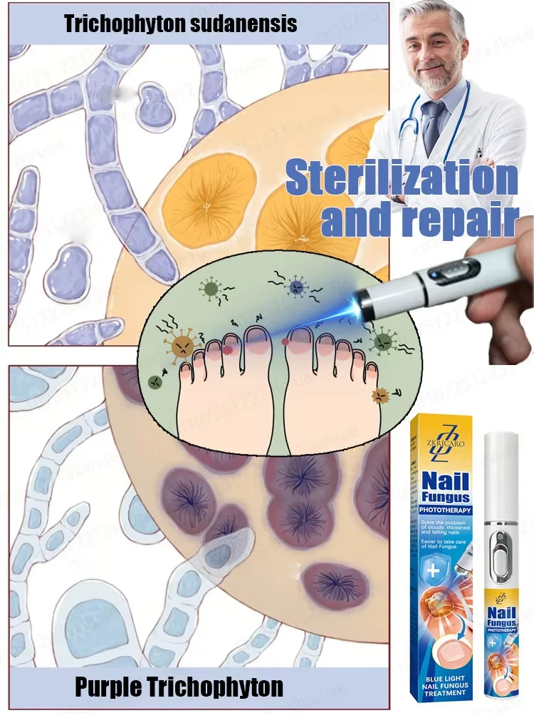 Лазер онихомикозые усадхадаг, дахин үүсэхэгүй, хадааһа гэмтээхэгүй, онихомикозые эрдэмэй аргаар эмшэлдэг