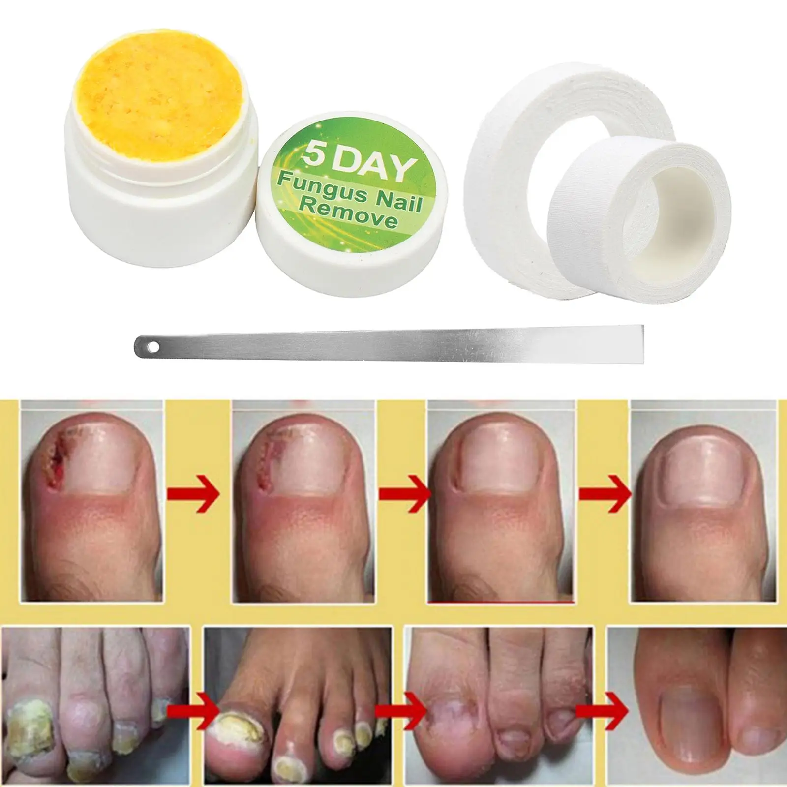 20g Anti Fungus Nail Fungus Treatment Cream Paronychia Anti Fungal Nail Treatments Nail Repair Liquid Foot Care Tools