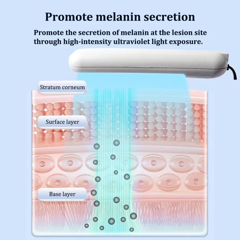 UVB العلاج بالضوء ضيق 311nm الأشعة فوق البنفسجية العلاج بالضوء مصباح الأشعة فوق البنفسجية العلاج بالضوء الصدفية للبهاق