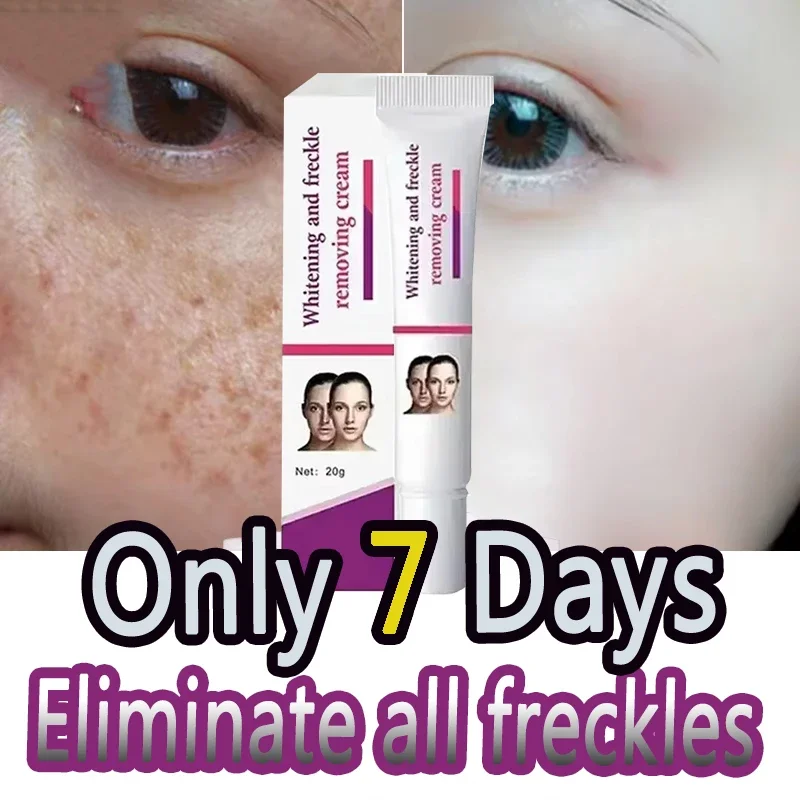 

Freckles Removal Cream Remove Skin Dark Spot Melasma Age Spots Sunspots Whitening And Freckle Removing Cream