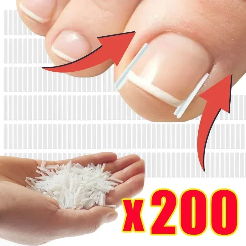 

200Pcs Ingrown Toenail Correction Tool Ingrown Toe Nail Treatment Elastic Patch Sticker Straightening Clip Brace Pedicure Tools