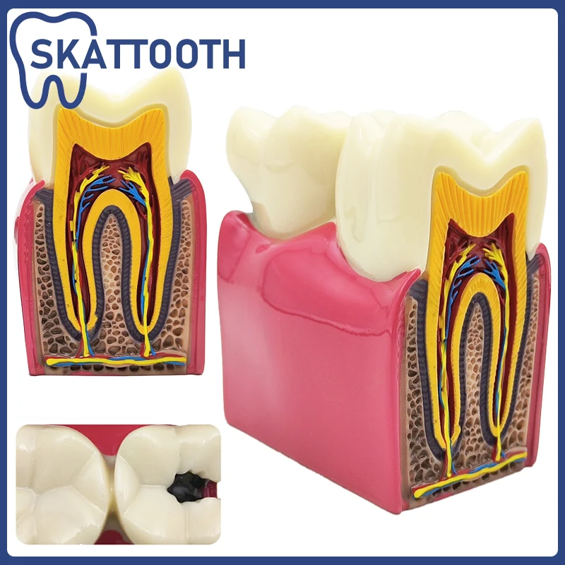 Модель зубного кариеса 6/8X Учебная модель сравнения кариеса