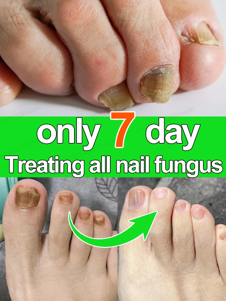 Nail fungus treatment essential oil, repair onychomycosis in 7 days