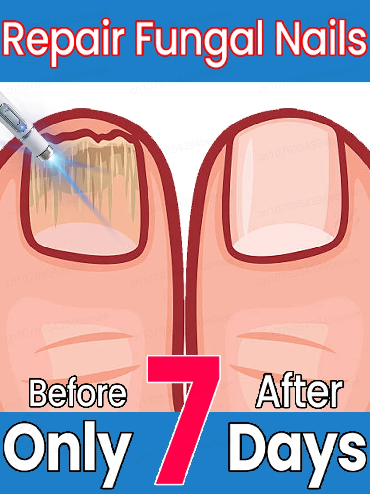 

Smooth and clean nails, no more worries about onychomycosis