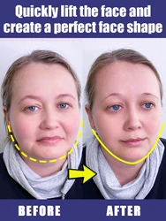 Remove double chin v lifting