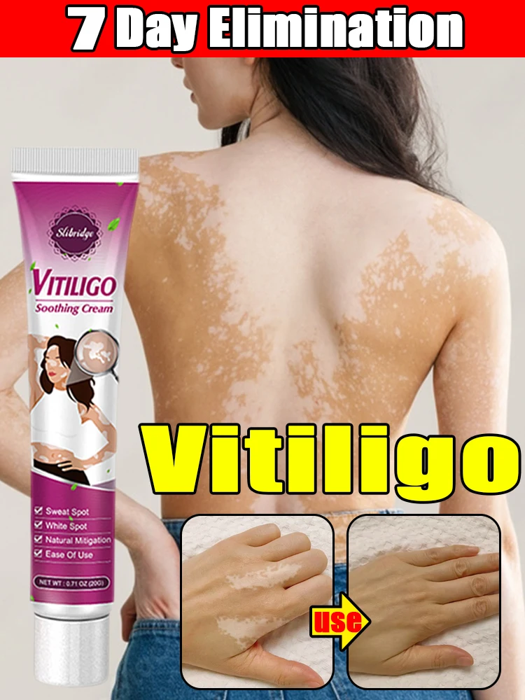 Crema de vitiligo para tratamiento efectivo, productos de punto blanco de desalinización