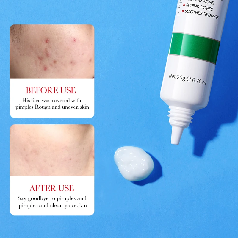 20g Salicylic acid cream Acne Treatment Acne Gel Helps Clear Acne Smooth Skin Care for Blackheads, Enlarged Pores Face Care