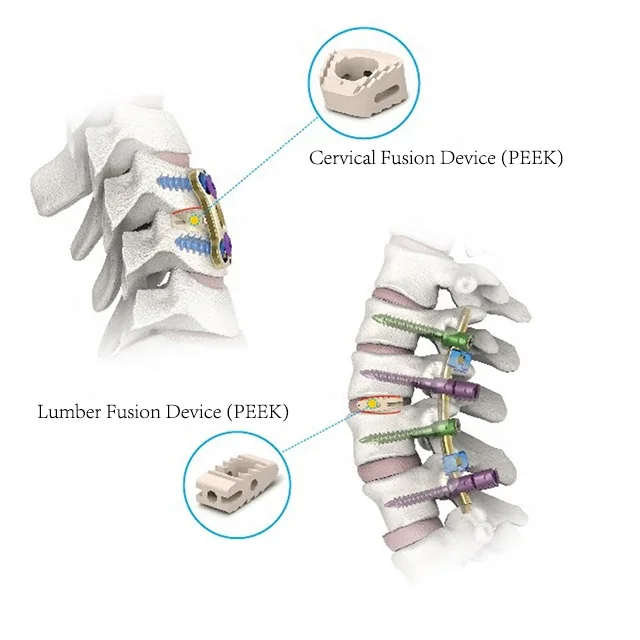 Jaulas de fusión Lumbar PLIF PEEK para columna vertebral, jaula Cervical, implantes ortopédicos de titanio, tornillos espinales, instrumentos ortopédicos