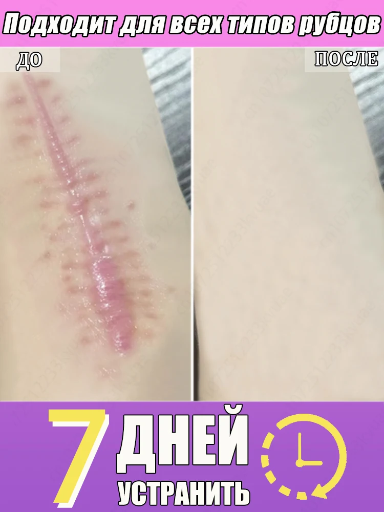 

Все еще беспокоят шрамы Избавьтесь от всех видов шрамов всего за 7 дней!