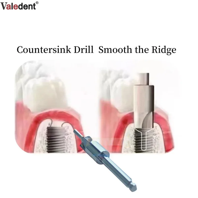 

Dental Bone Collector Bone Expansion Drills 4.5/5.2mm Planting Drill Bit Stainless Steel Instruments Tools Bone Harvest Drill