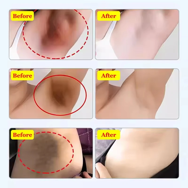 كريم تبييض الأجزاء الخاصة تحت الإبط مصل تبييض تبييض بعقب الركبة سطع الفخذ الداخلي الأجزاء الحميمة إزالة الميلانين الداكن #4