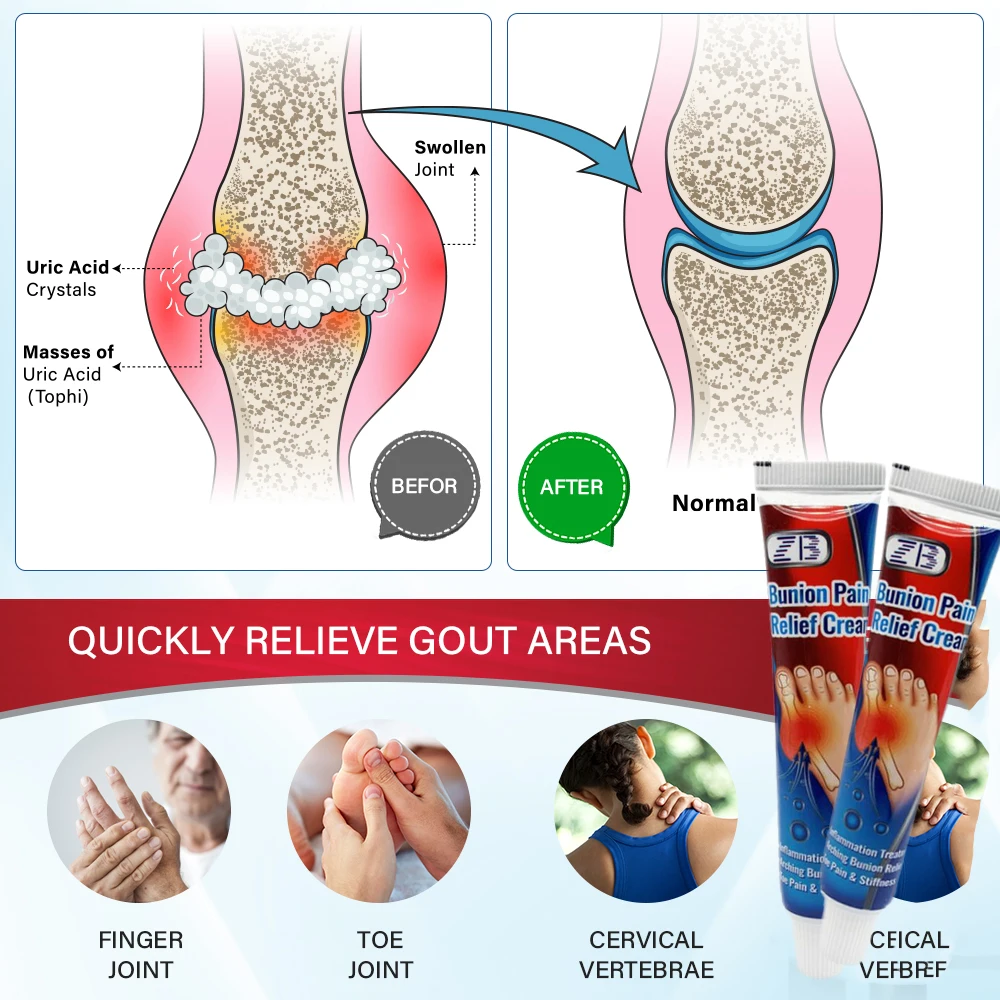 New 2023 20g Gout Treatment Ointment Hallux Valgus Bunion Toe Swelling Pain Relief Ointment Joint Arthritis Medical Plaster